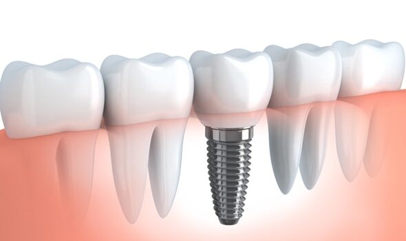 implantes_dentales_2-min Implantes Dentales